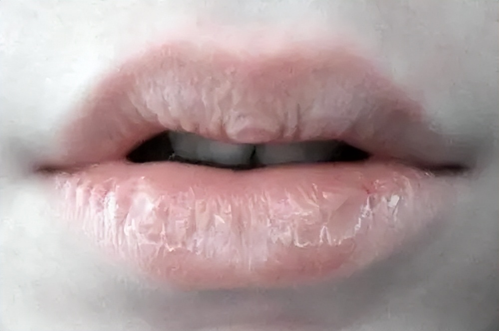 孩子嘴唇干裂出血怎么办?听听儿科医生的建议,妈妈可以学起来