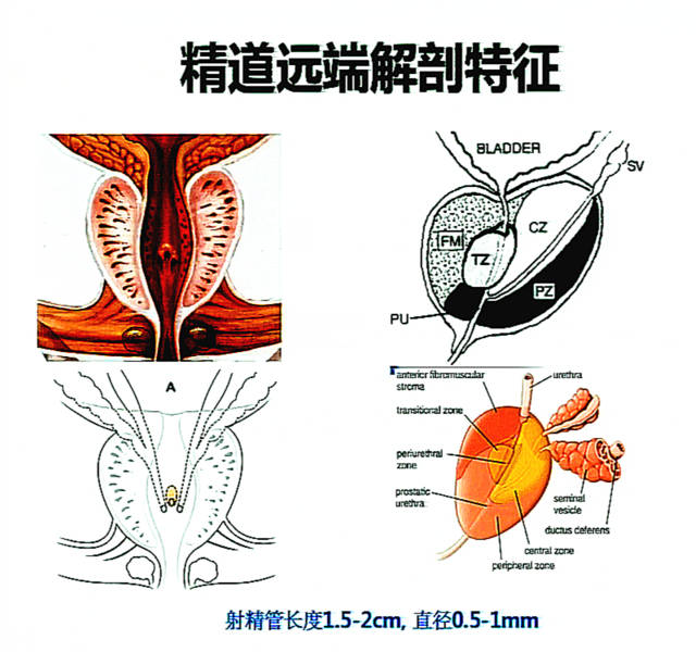 精囊炎让男性苦不堪言,它的存在症状很多,人们需注意哪些事项?