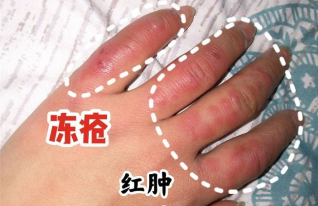 冬天生疮红肿刺痒!不足三个月竟彻底治愈,这五大方法都是敲门砖