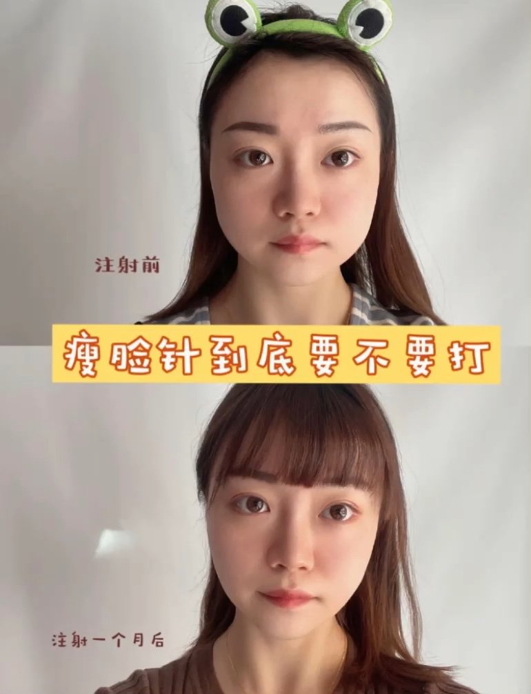 怎么看自己是不是适合瘦脸针?如何做好手术前后准备?