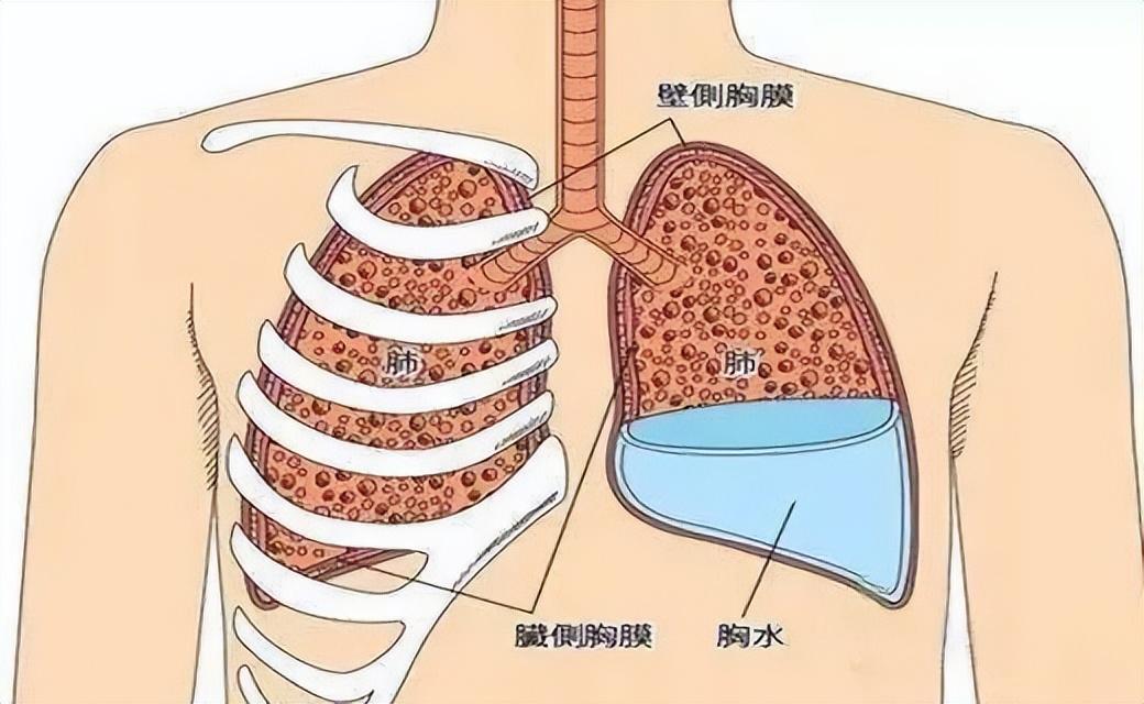胸腔积液示意图图片