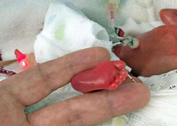 出生仅24厘米的美国拇指姑娘,医生断定不能活过1岁,如今怎样?