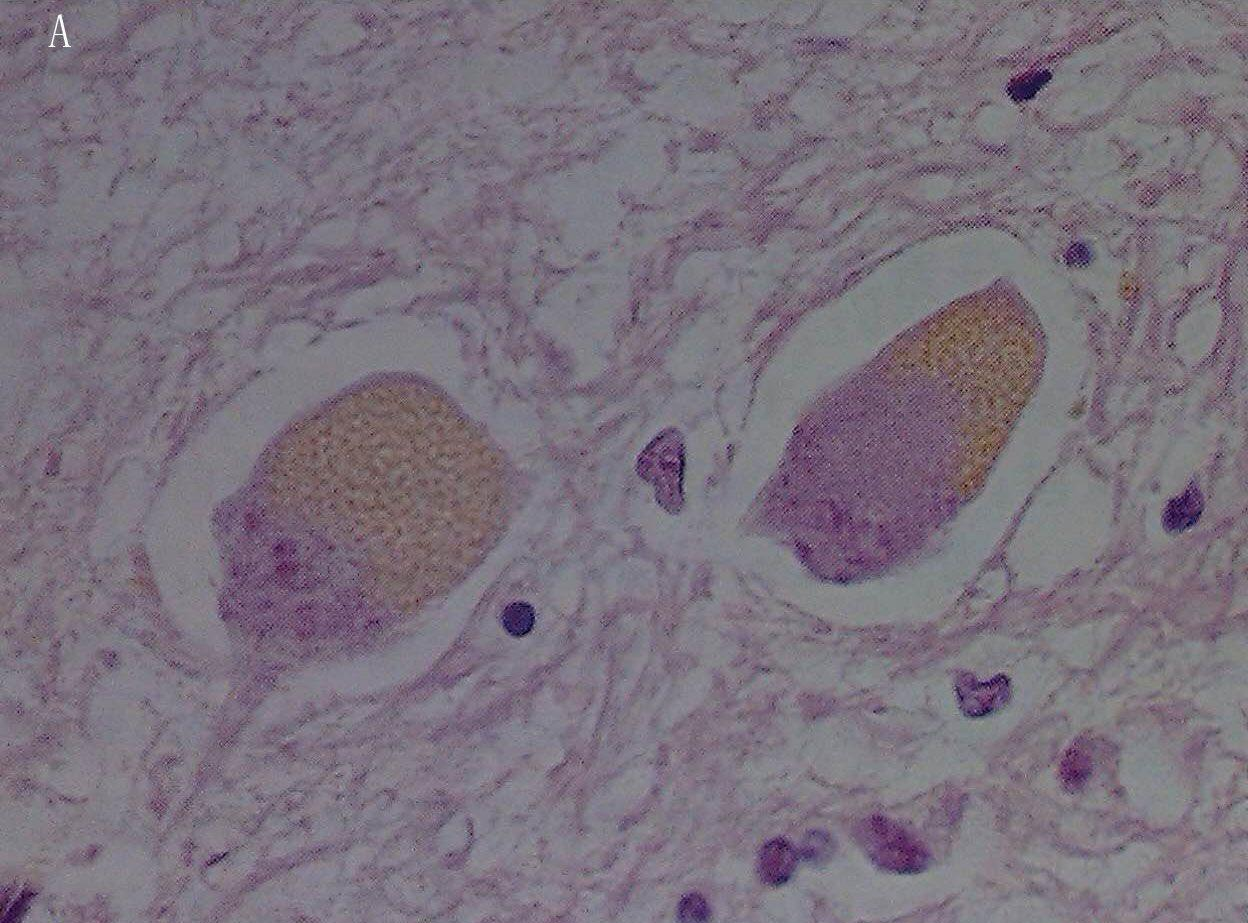 神经元蜡样脂褐质沉积症是遗传疾病,多发生于儿童期,治疗困难