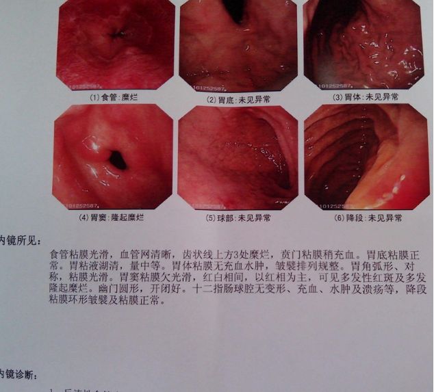 做完胃镜,怎么看胃有没有问题呢?教你快速读懂胃镜报告