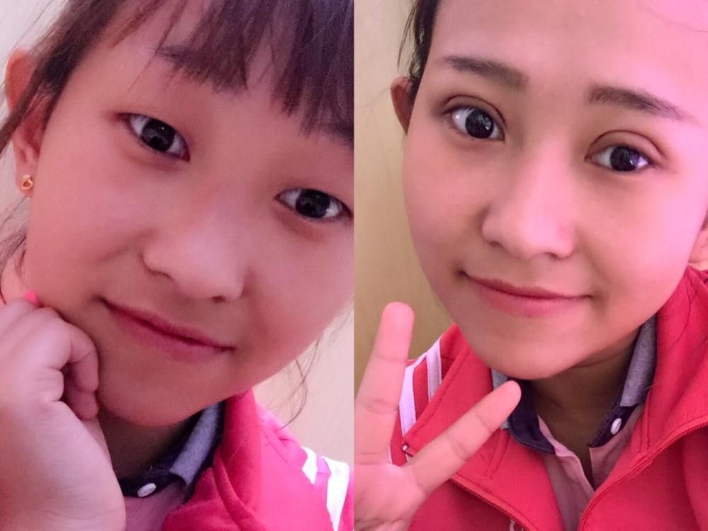 吸雕双眼皮是怎么做的呢?有哪些优势?