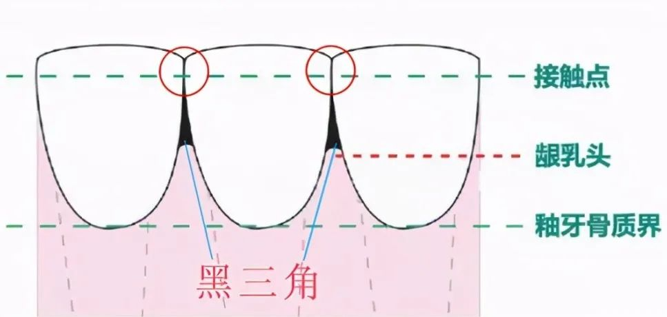 昆明牙科健康科普:什么叫牙齿黑三角?牙齿黑三角怎么形成的?