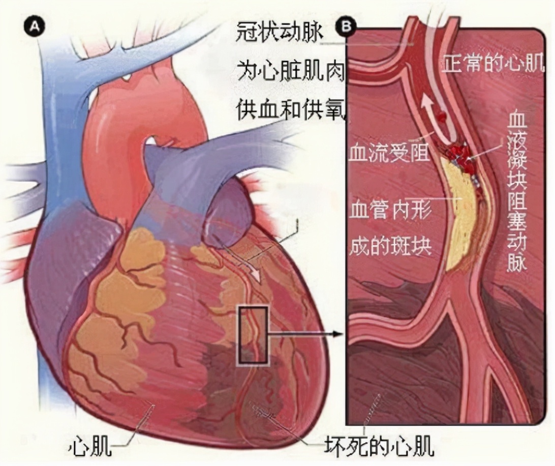 老何戒烟3个月,却突发心肌梗死,家属质疑戒烟不好,看医生解释