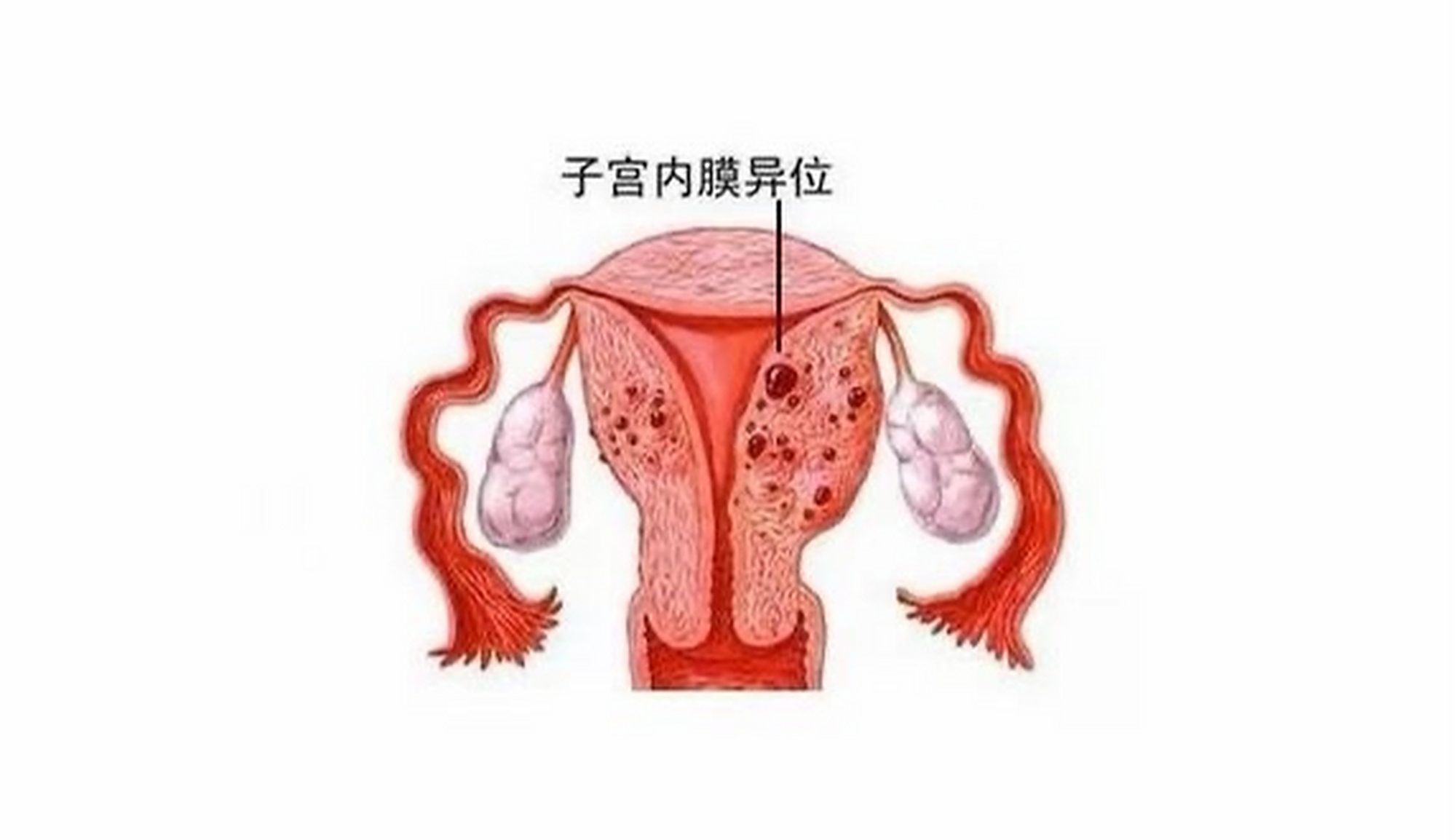 子宫内膜异位症会复发吗?听听医生怎么说