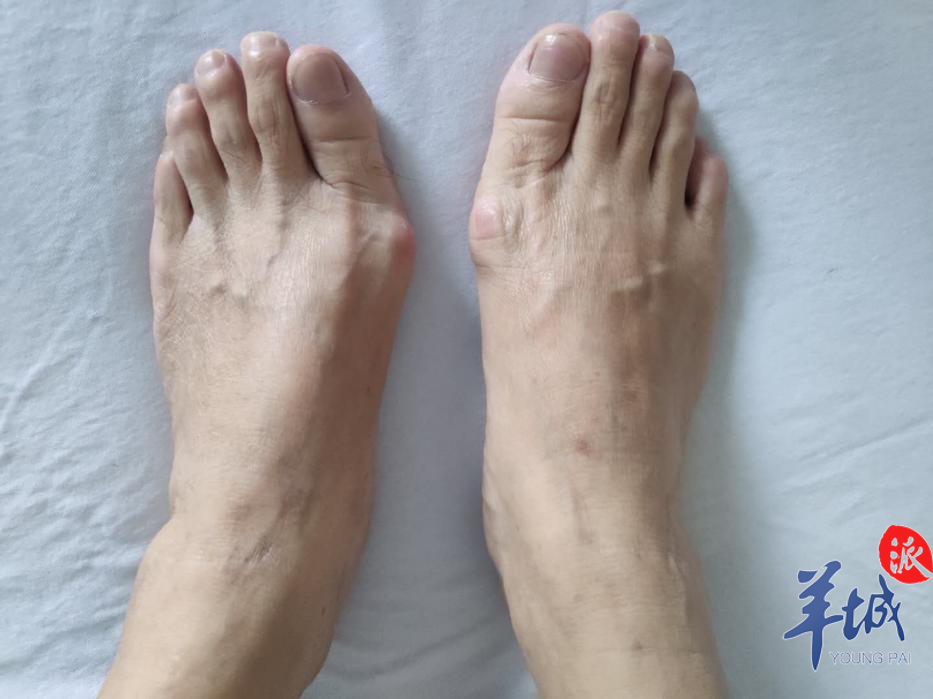 爱美常穿高跟鞋 当心踩出拇外翻 来自百家号 羊城派 不错网