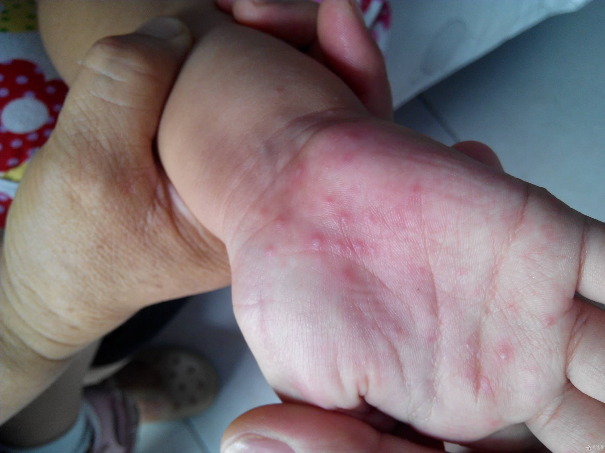 疱疹性湿疹一般是湿疹儿童多发,往往病情严重,需及时住院治疗