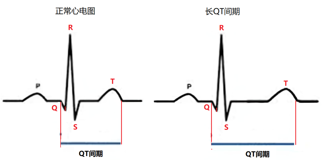 心电图pr间期图片图片