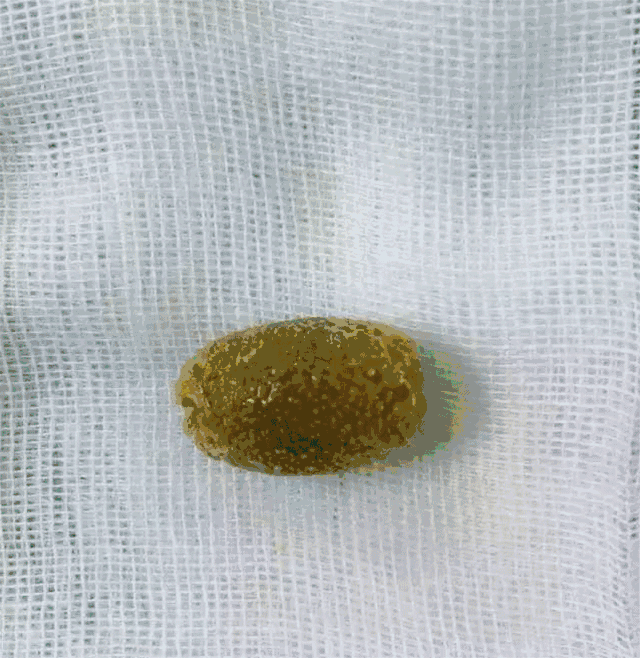 胆结石9mm,没必要手术!可以化石排石!请刀下留"胆"!