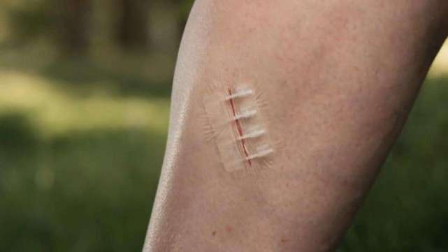 优质回答 大学生发明"拉链创可贴",不用缝针只需一拉,无伤口不留疤!