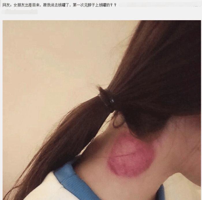 "女友出差回家,脖子上是草莓印吗?"我太难了!哈哈哈