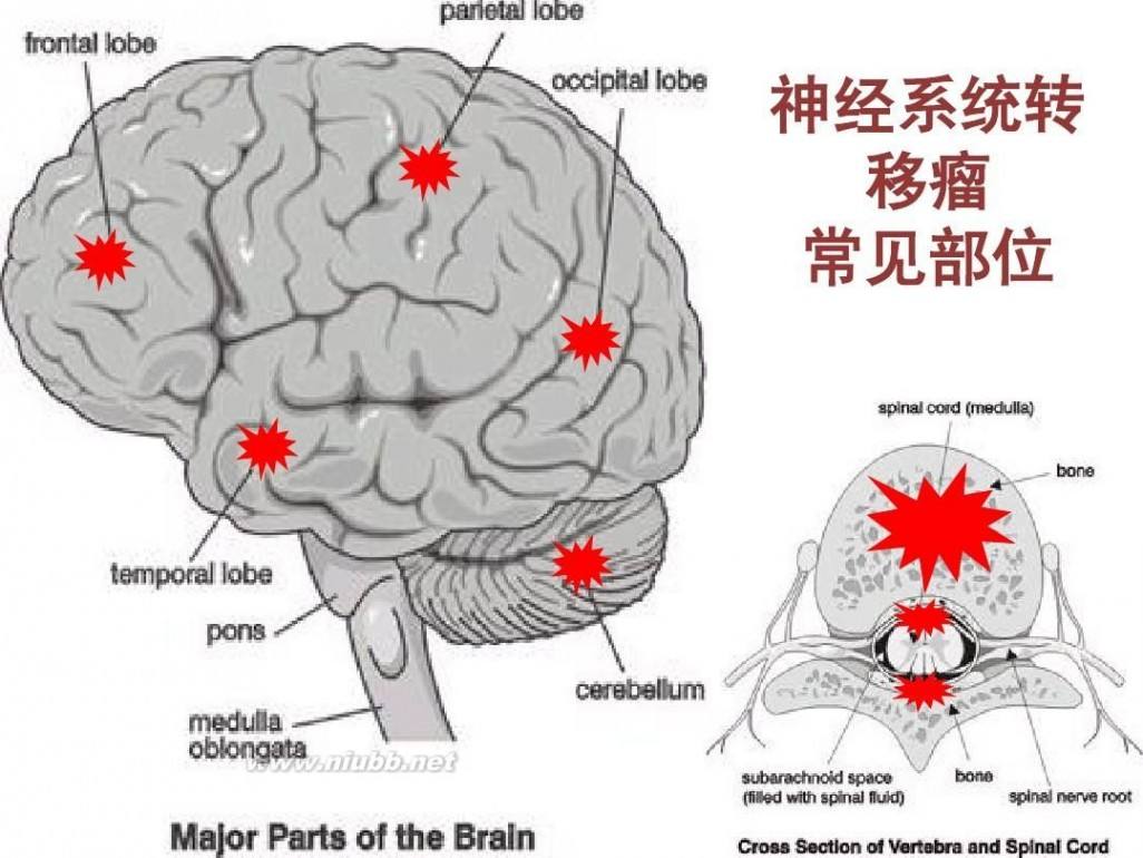 中枢神经系统原发性和转移性肿瘤