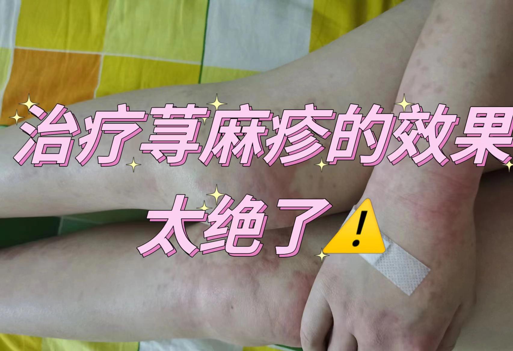 荨麻疹反反复复折磨人?10年治疗经验无保留分享!删前必看!