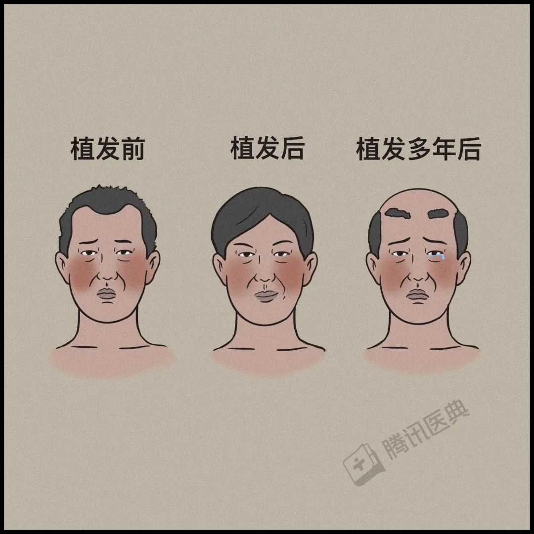 一篇帮人类打败脱发的文章