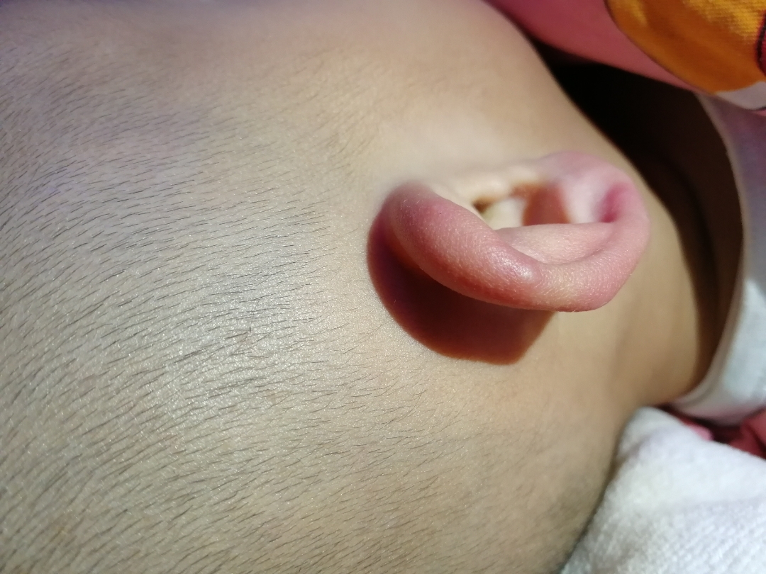 儿童耳廓软骨膜炎症状图片