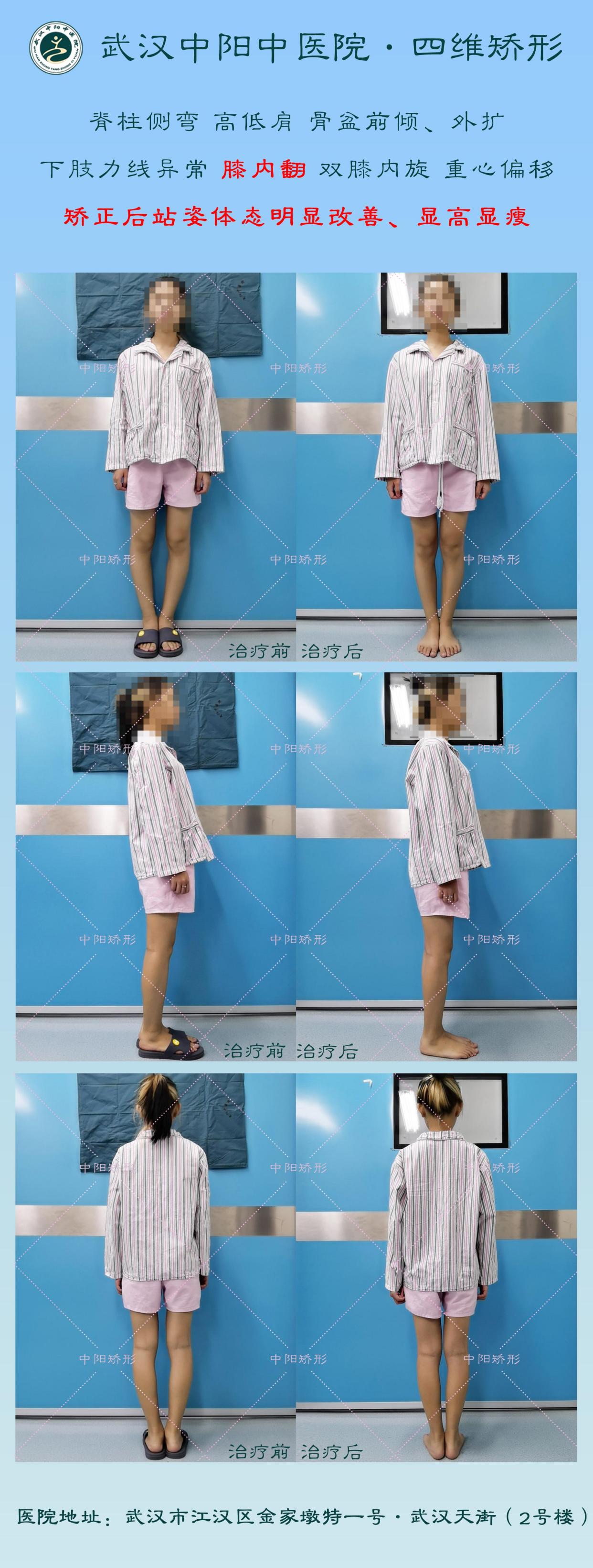 o型腿的骨头结构是异常的吗?武汉中阳中医院四维矫形微创矫正