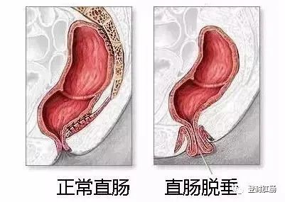当全层直肠脱出至肛门外时,我们称之为直肠全层脱垂;若仅黏膜