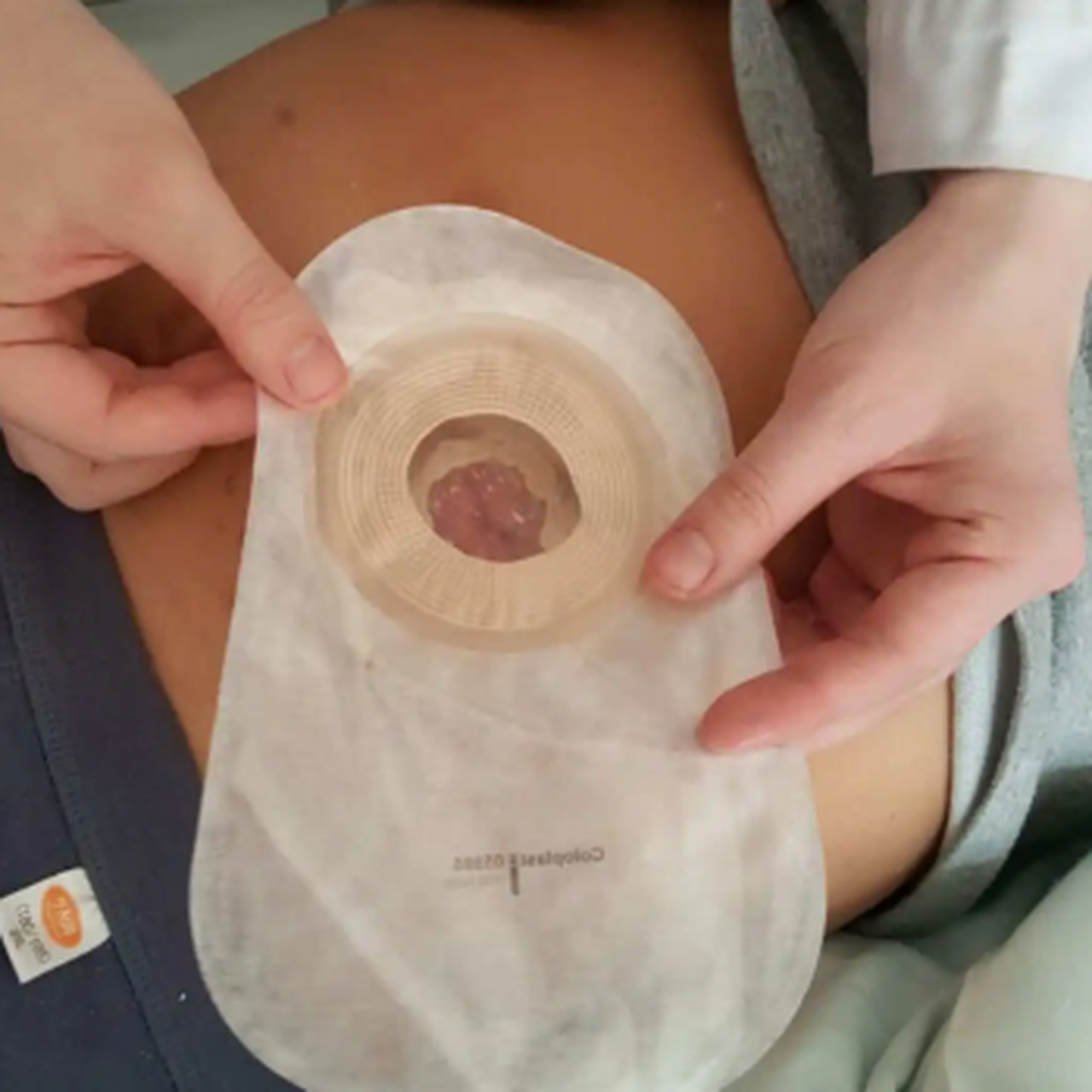 半年前,我爸爸由于直肠癌,做了肛门切除手术,安装了人粪口.