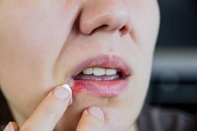 嘴上长水泡瘙痒,刺痛?别以为只是上火而已,4个情况要留意