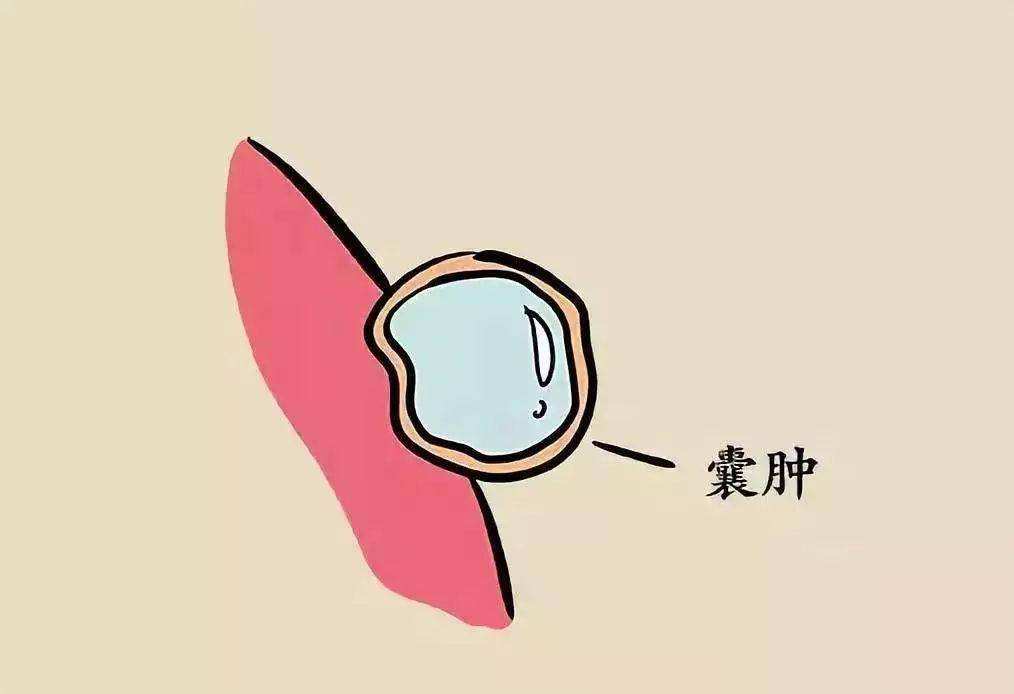 患上卵巢囊肿,身体会发出哪些信号?有这些症状别大意