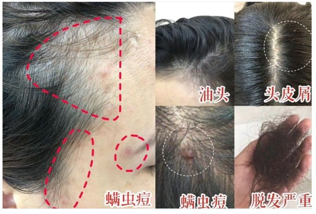 原来螨虫最怕的不是暴晒,学一个新方法,比晒被子管用