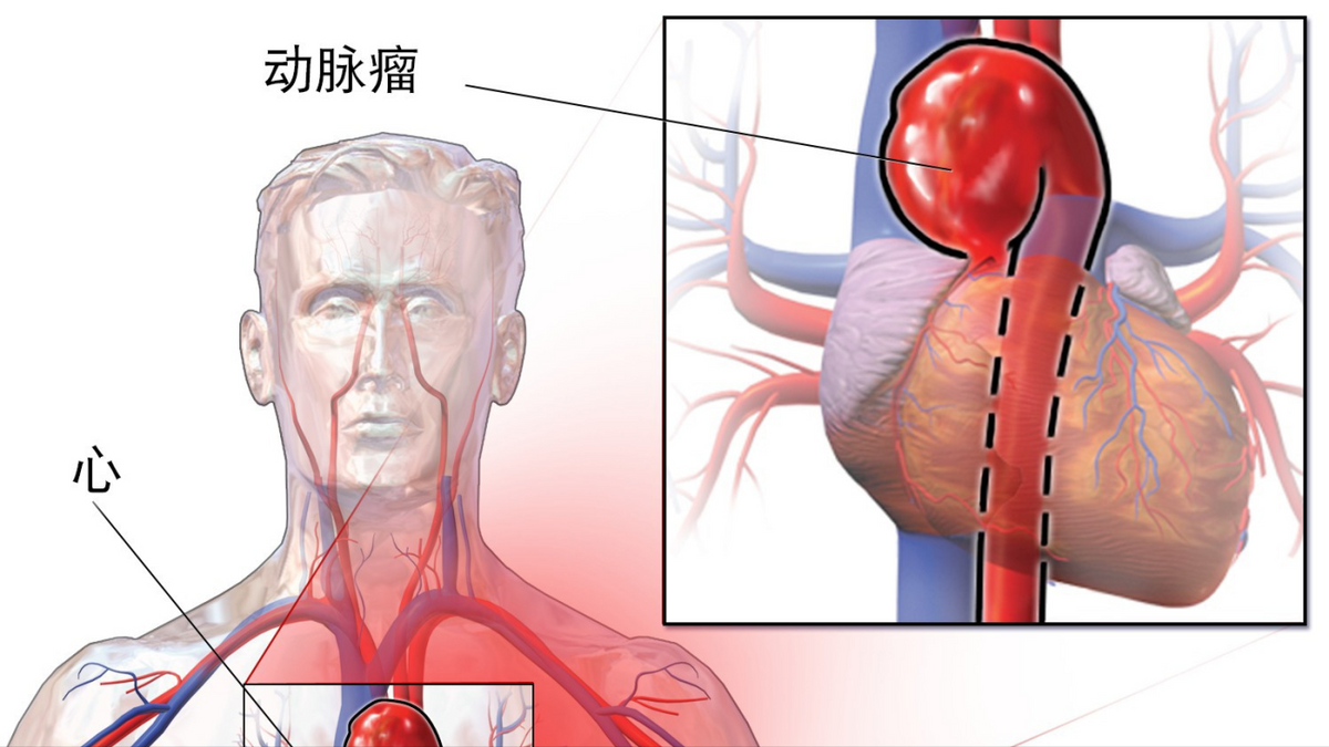 動脈瘤是什麼,是真的腫瘤嗎,危害大嗎?醫生給你解釋解釋