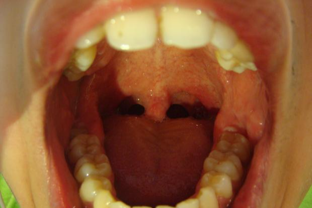 腭咽闭合不全的患者,常表现为发音不清的症状,多由软腭病变导致