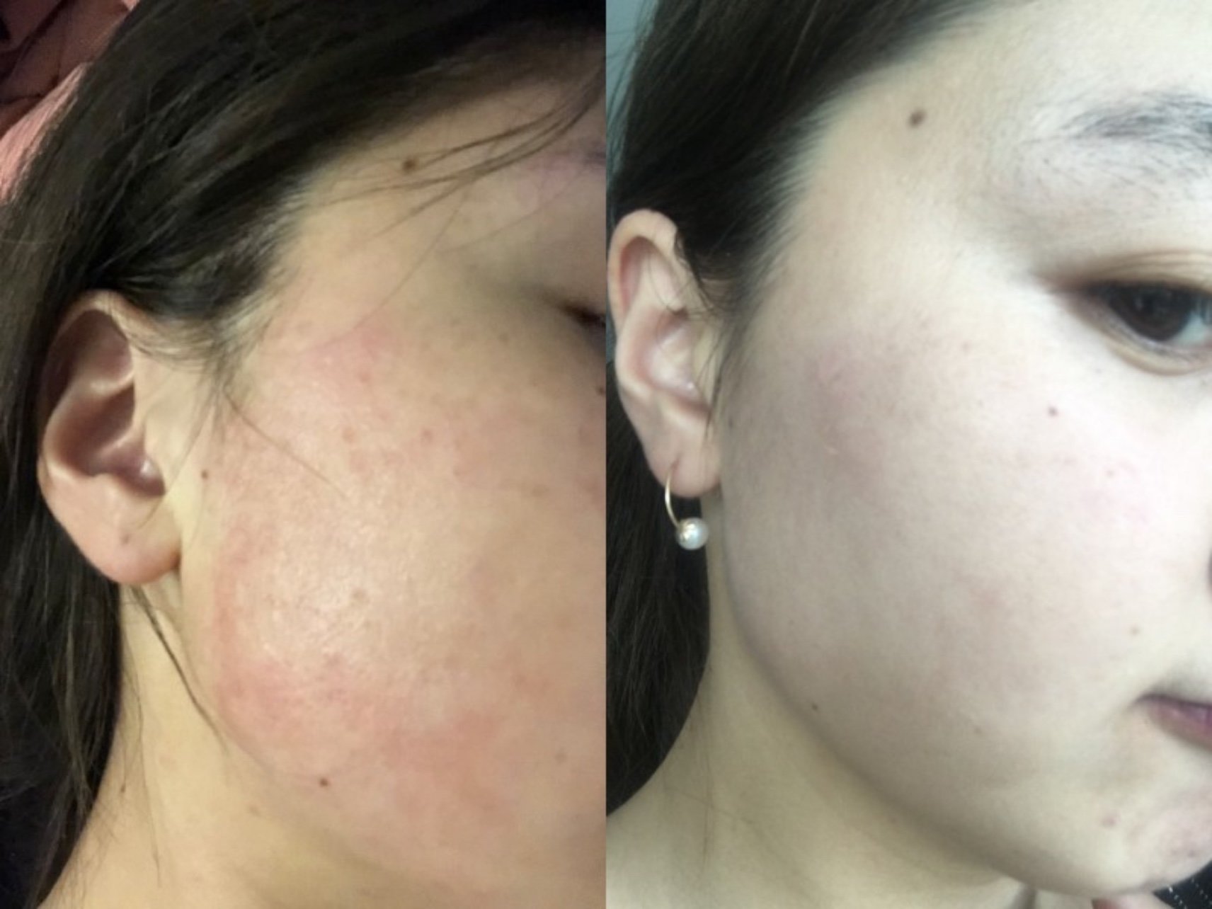 敏感肌是怎么形成的?在变美的路上,该如何养护并改善敏感肌?