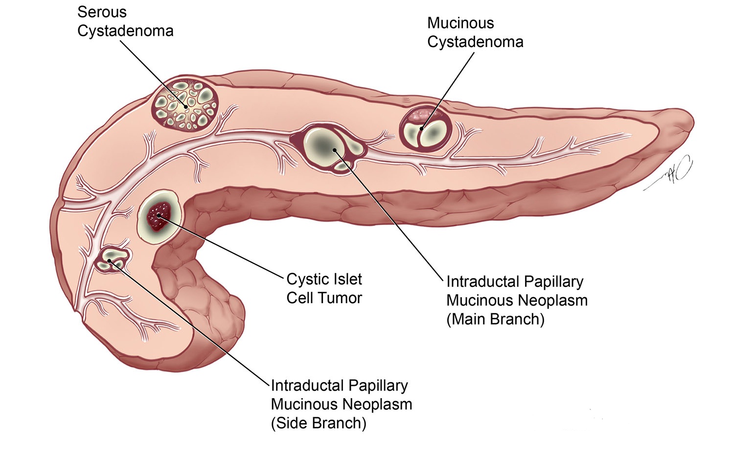 自身免疫性胰腺炎有典型症状或检查疑似该病时,应尽快就医