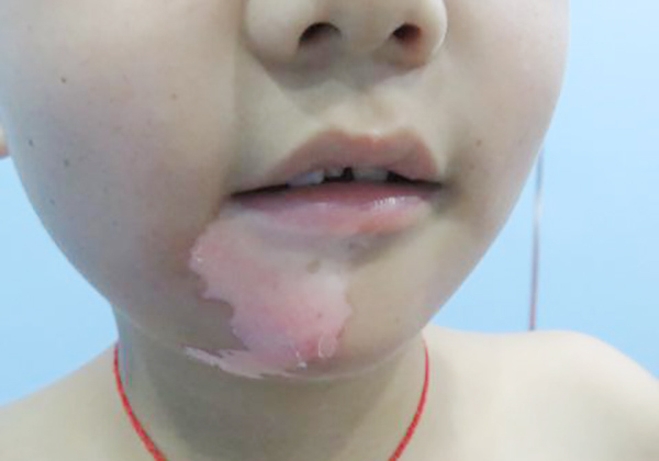 小孩患上白斑可不同于大人,家长"乱治"会害了孩子!