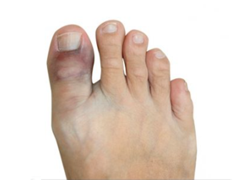 脚趾头碰了一下,一直好不了,如何分辨扭伤还是骨折?