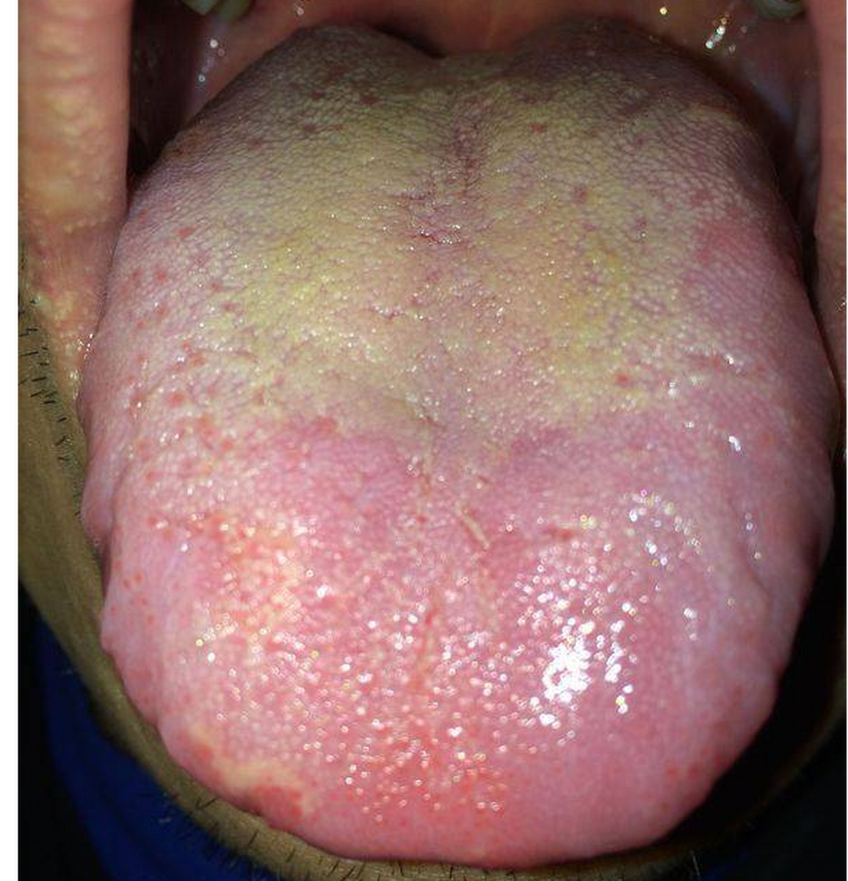 舌苔越厚,病根越深;出现这几种厚腻舌苔,要注意了  第一种:舌面布满白