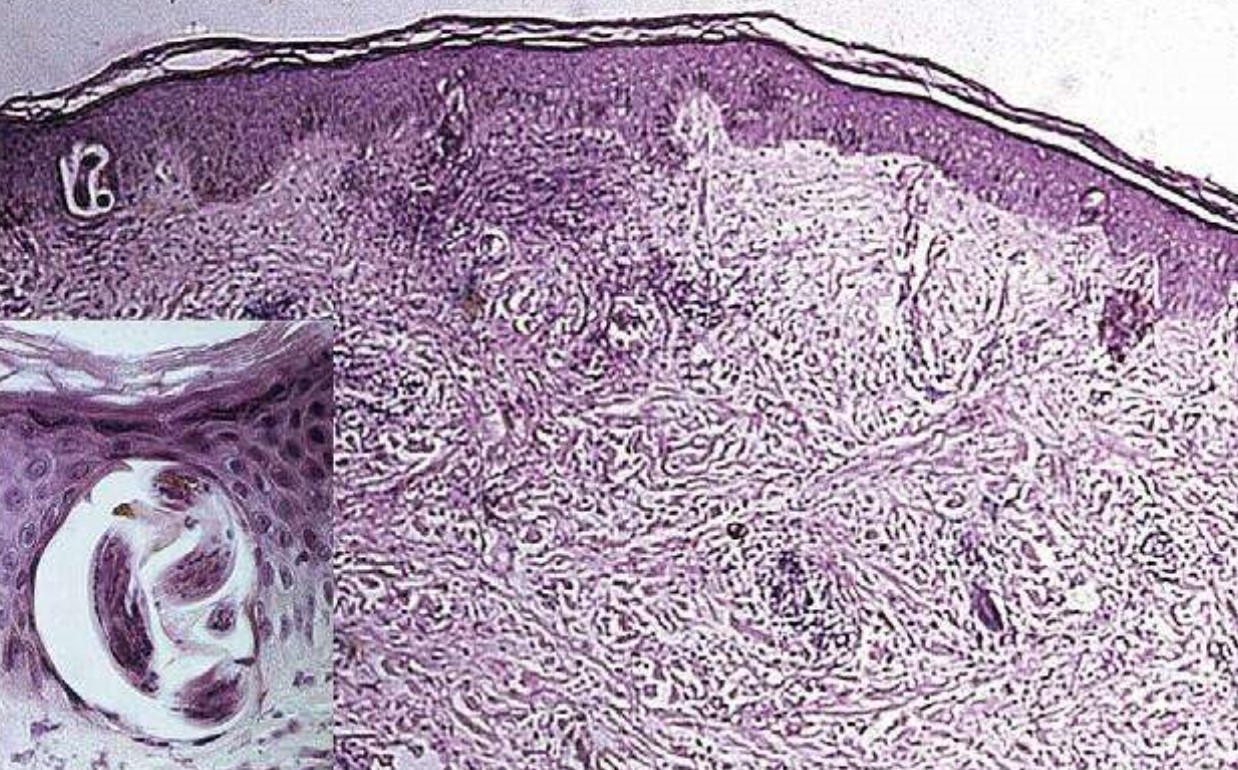 匐行性穿通性弹力纤维病,一种较为罕见的穿通性皮肤病,不会传染