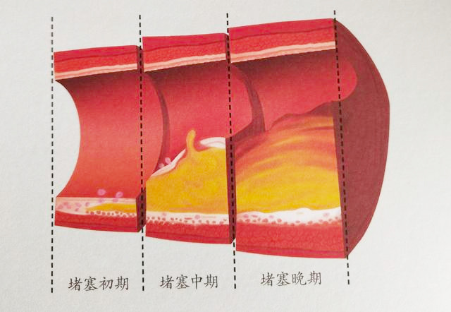 血管堵到什么程度人体才会出现明显症状医生的回答让人想不到