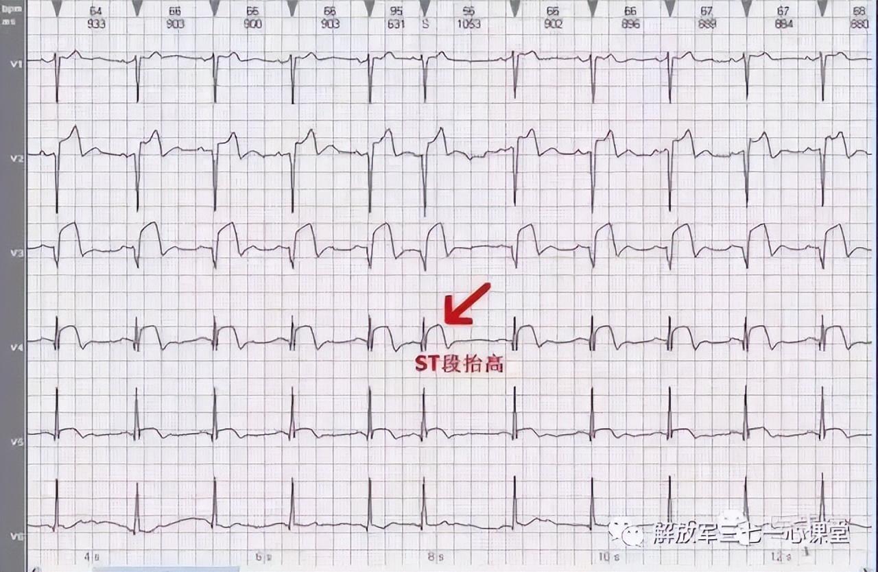 缺血性心肌病心电图图片