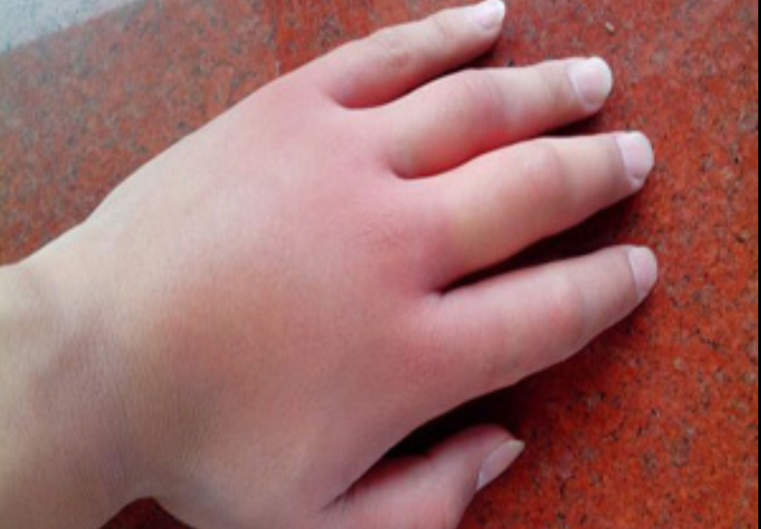 遗传性血管性水肿是罕见遗传病,患者多腹痛四肢水肿,请及时检查