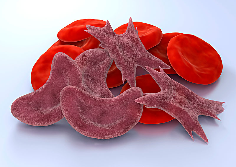 镰刀型细胞贫血,红细胞呈新月形或镰刀形,身体产生异常形状的病