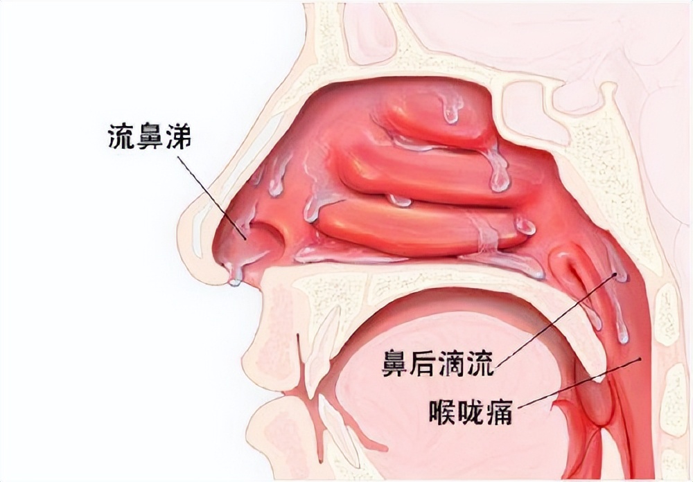 感冒为什么鼻涕多百科在线 感冒为什么鼻涕多百科在线