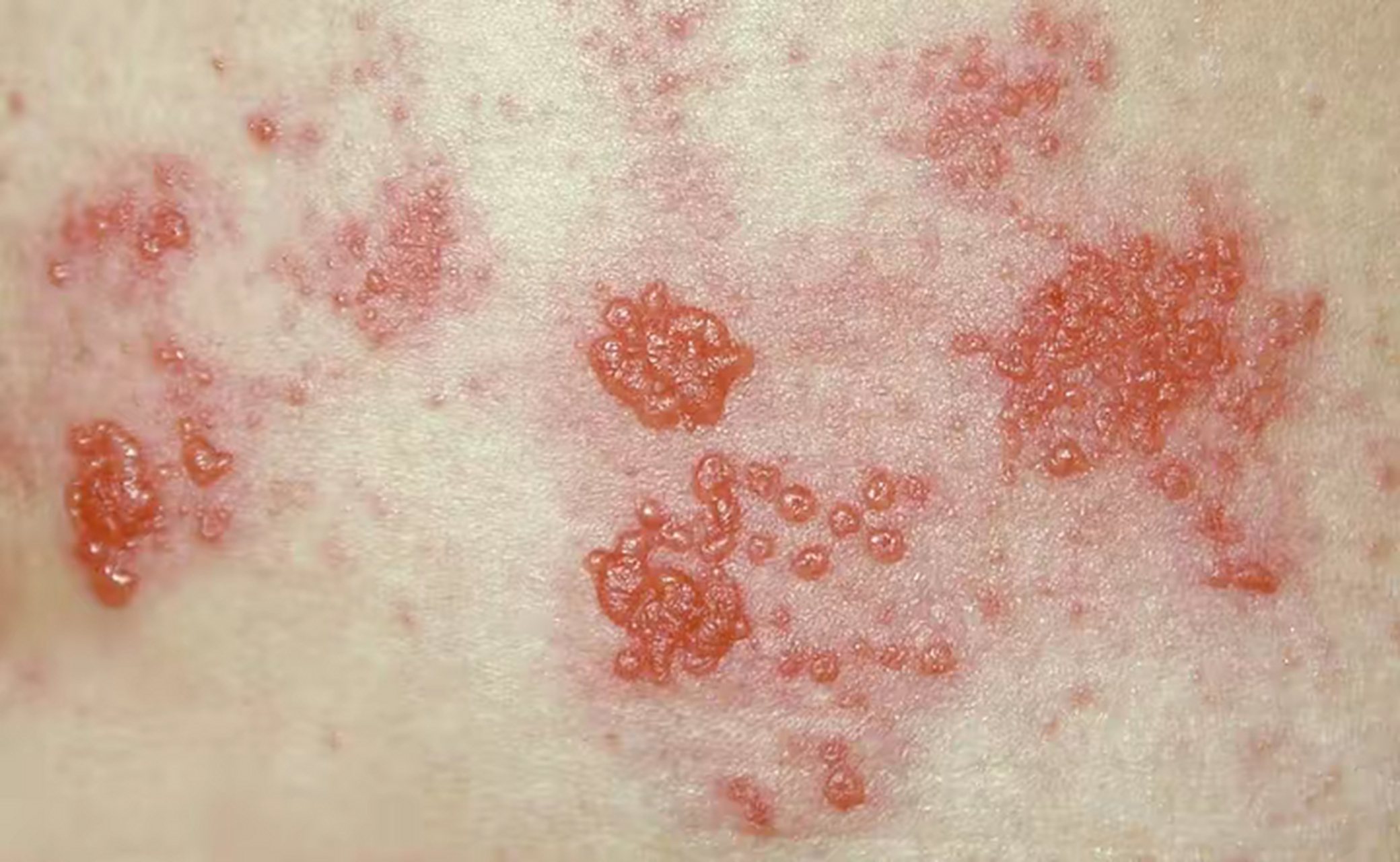 这也是为什么带状疱疹发病的大多是体质虚弱的老年人.