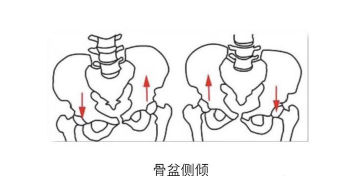 骨盆后倾的症状图片图片