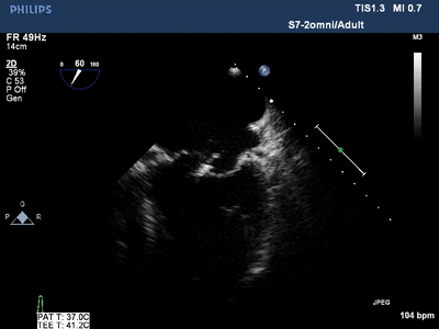 技术导航|心脏超声检查新视窗——经食管超声心动图检查
