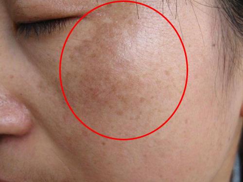 色斑怎样才能去除,教你几招轻松解决!