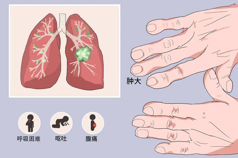 肺结节有什么症状图片