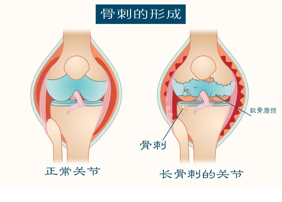 骨刺长在哪里图片图片