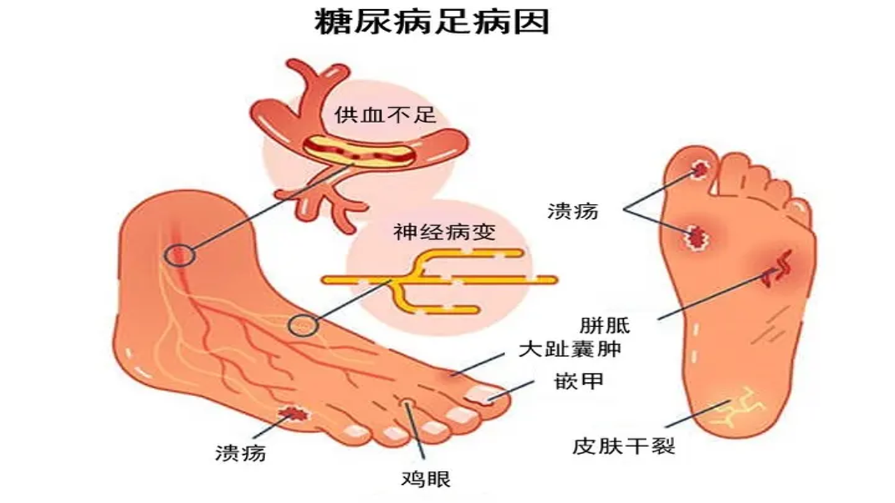 为什么糖尿病足会烂脚?如何预防?