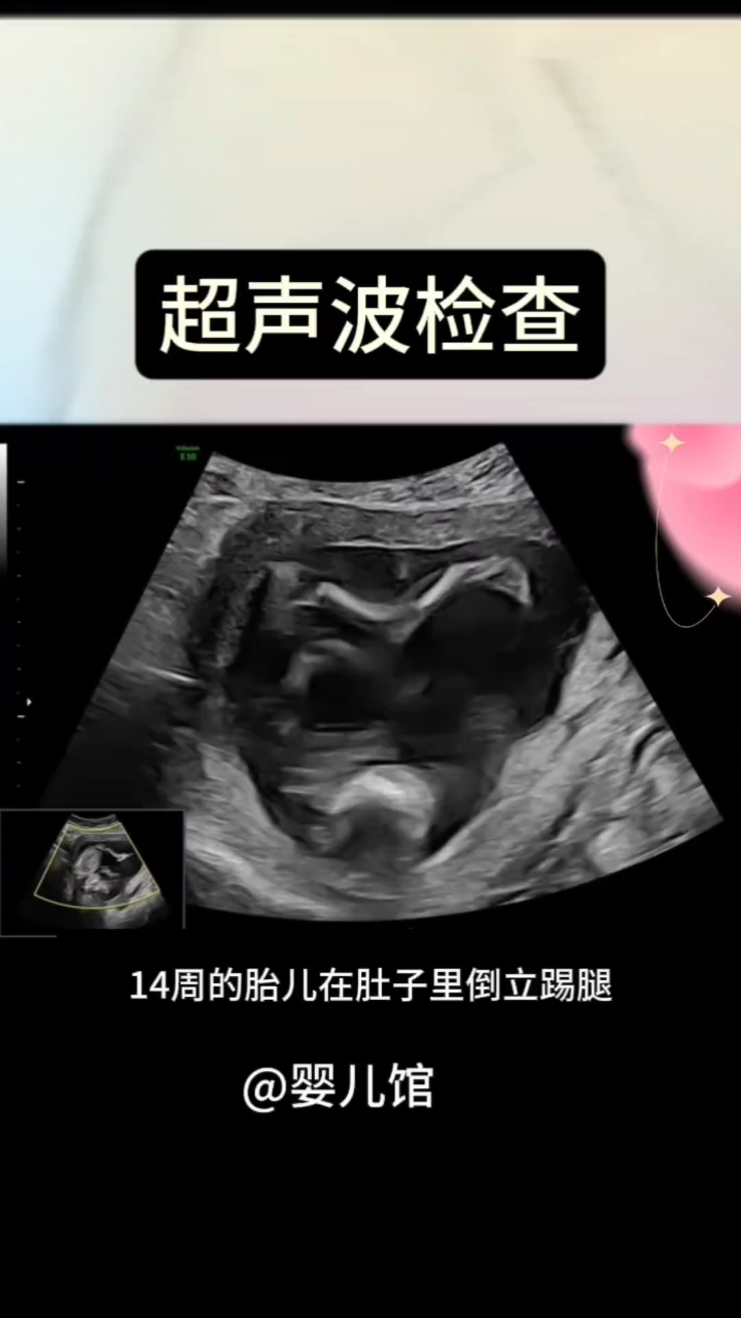 超声波检查14周胎儿的样子