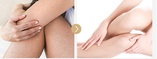 鸡皮肤的尴尬(为什么会出现鸡皮肤) 鸡皮肤的尴尬(为什么会出现鸡皮肤)